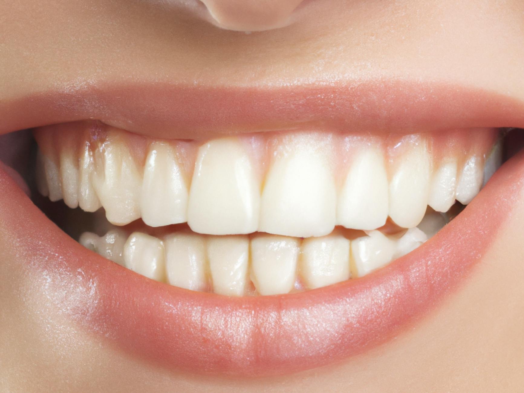 porcelain-veneers gallery 2